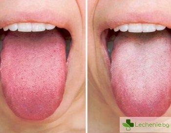 Симптоми и лечение на гъбичките по езика